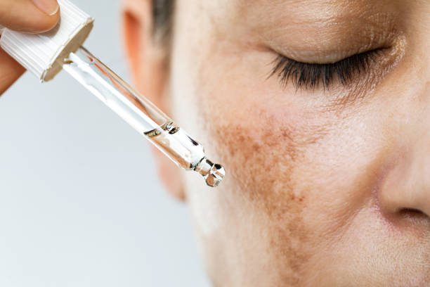 summer skin recovery — woman applying hydrating skincare product outdoors